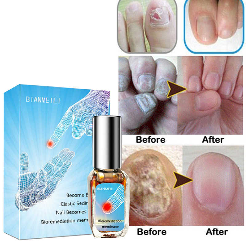 Как лечить грибок ногтей - coolaser clinic