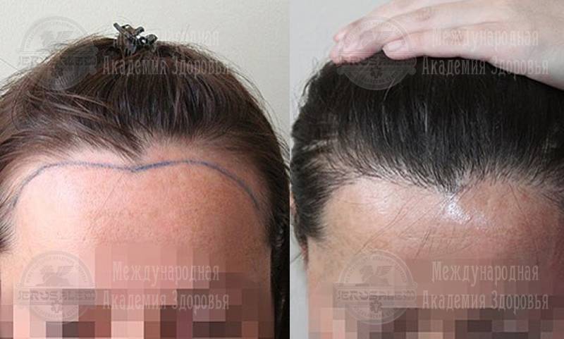 Плазмолифтинг для волос, цены на плазмолифтинг волосистой части головы в москве – an-tech labs