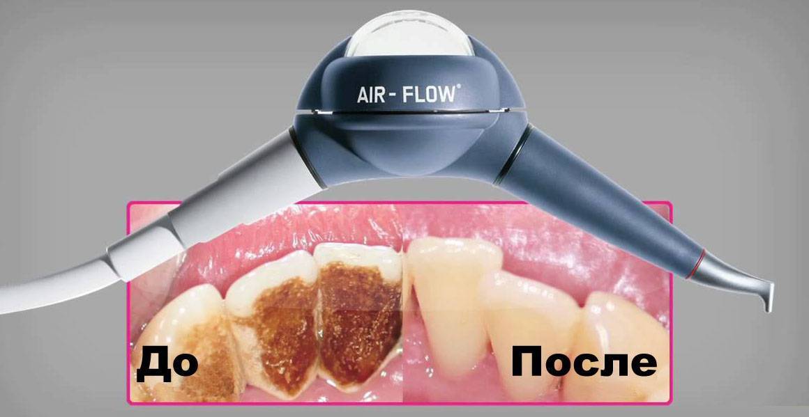 Чистка зубов air flow: особенности и преимущества