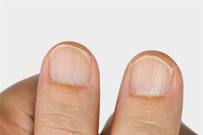 Белые полосы и пятна на ногтях – причины, диагностика и лечение