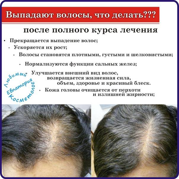 Методы и средства восстановления волос после выпадения: оценка эффективности | клиника hfe | дзен