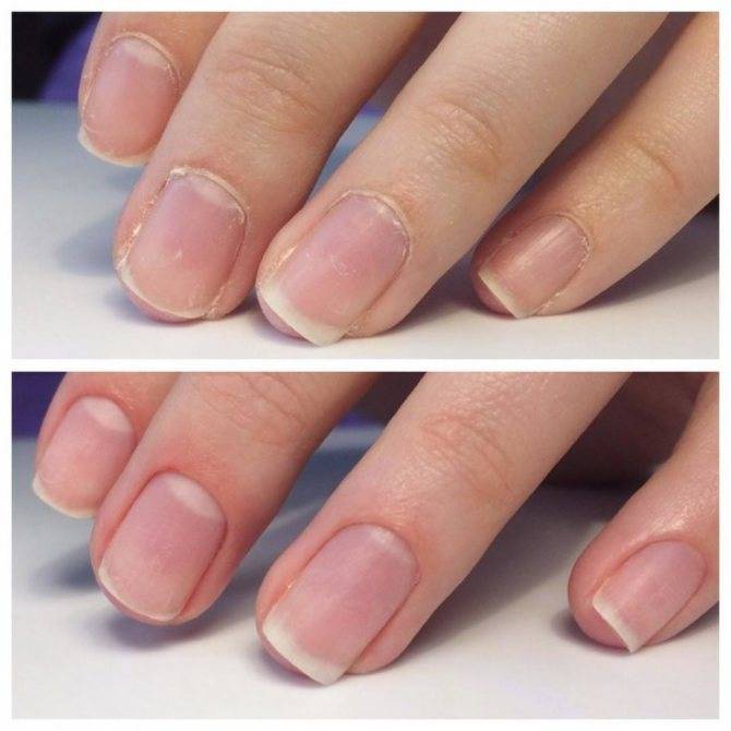 Как восстановить ногти после наращивания: домашние и профессиональные методы