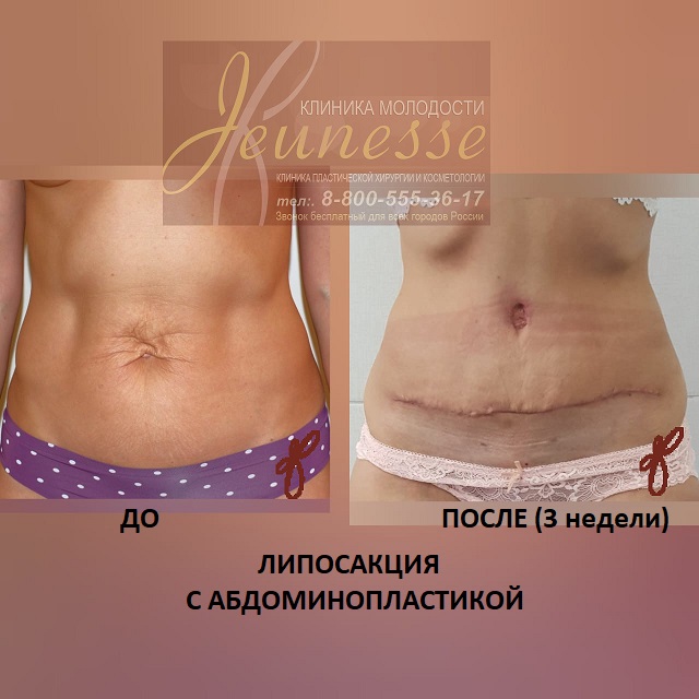 Липосакция живота. Как делается, виды операции, фото до и после, видео, отзывы