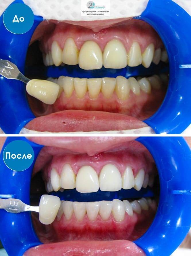 Как проходит процесс отбеливания зубов