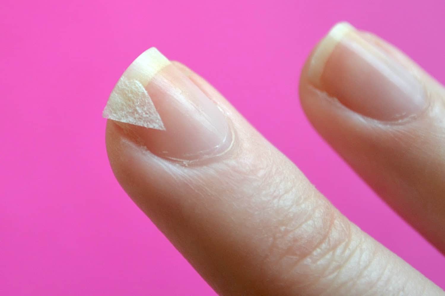 Онихолизис ногтей на руках: лечение, препараты, отзывы