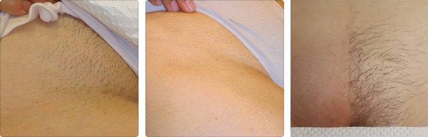Можно ли делать лазерную эпиляцию во время грудного вскармливания