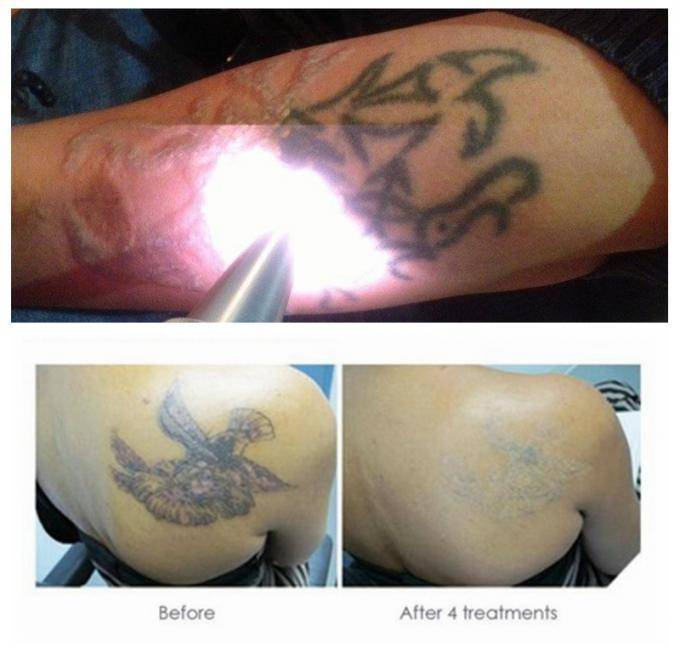 Как удалить татуировку и чем: лазером, способы выведения в домашних условиях, противопоказания