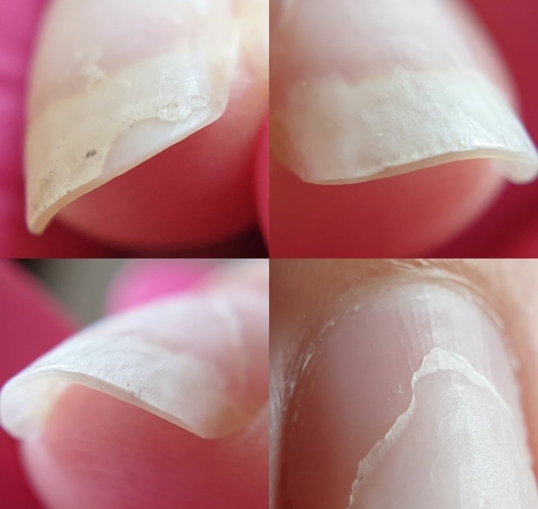 Отслоение ногтей (онихолизис) - лечение в ростове-на-дону