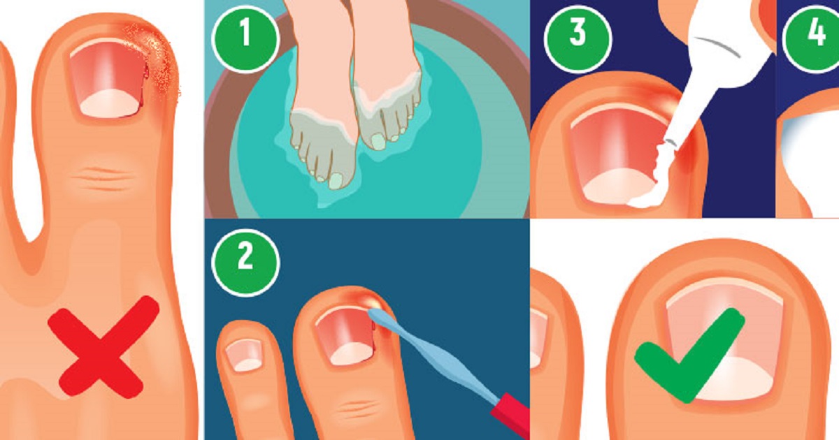 Вросший ноготь — диагностика, удаление и коррекция; лечение вросшего ногтя лазером в центре лазерной медицины лазмед клиника