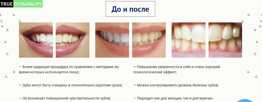 Как проводится отбеливание зубов в стоматологии?