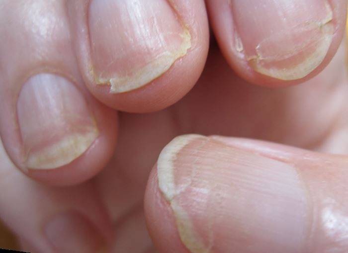 Дистрофия ногтя (ониходистрофия): симптомы, лечение ногтевой пластины | центр подологии елены шибановой
