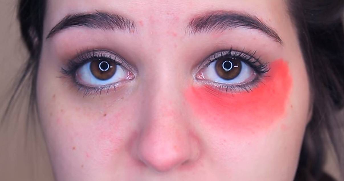 Хронические синяки и темные круги под глазами: как бороться?