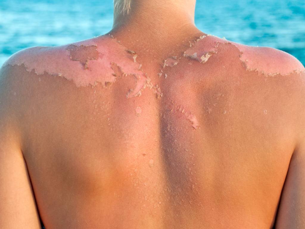 Восстановление кожи после лета, как сохранить красоту кожи после лета в статье pleyana