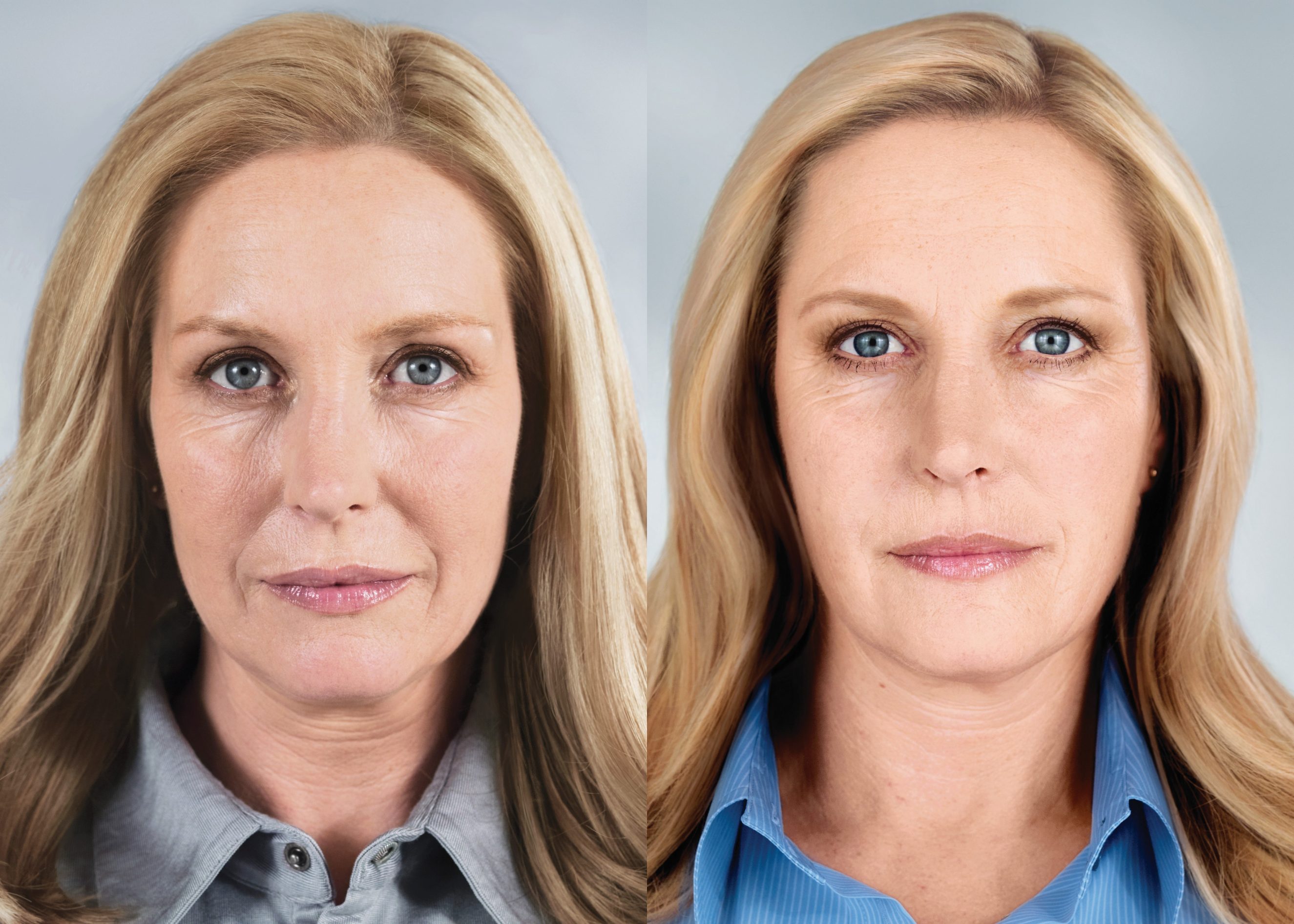 Ботокс до и после фото лицо 30 лет