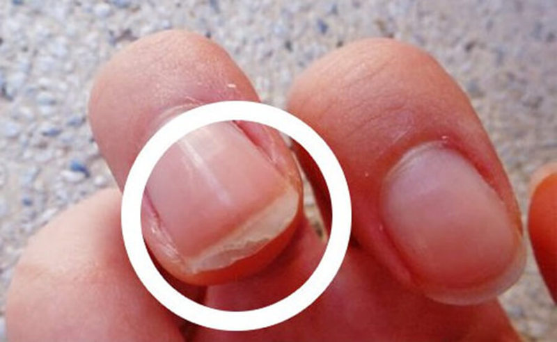Почему слоятся ногти и что нужно сделать, чтобы их вылечить?