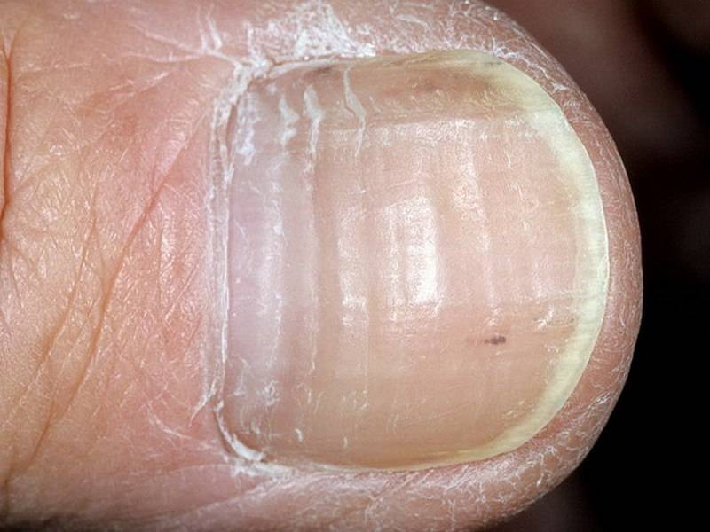 Ониходистрофия ногтей — причины и лечение