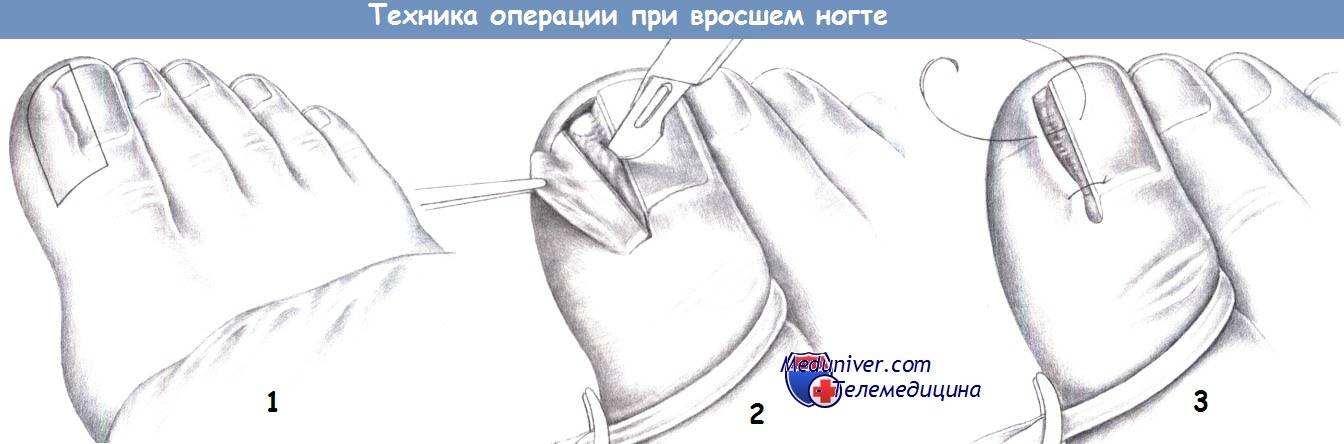 Вросший ноготь. причины, симптомы, диагностика и лечение вросшего ногтя. !