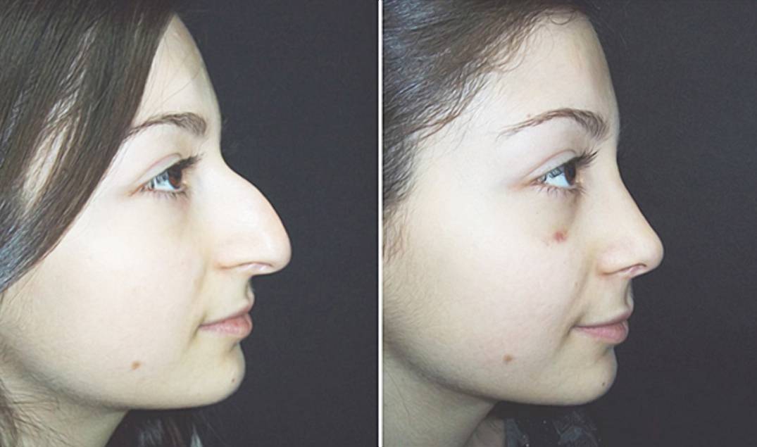 Нос с горбинкой – причины косметического дефекта, способы коррекции