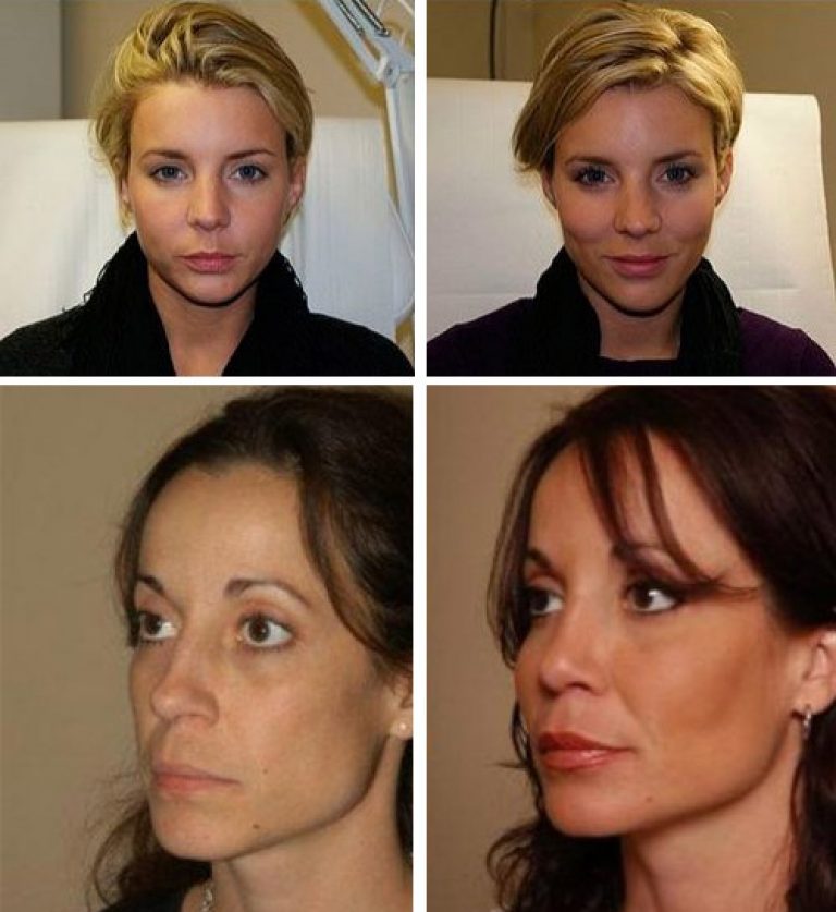 Эффект  "надутого лица": почему после введения филлеров возникает деформация внешности | а клиника