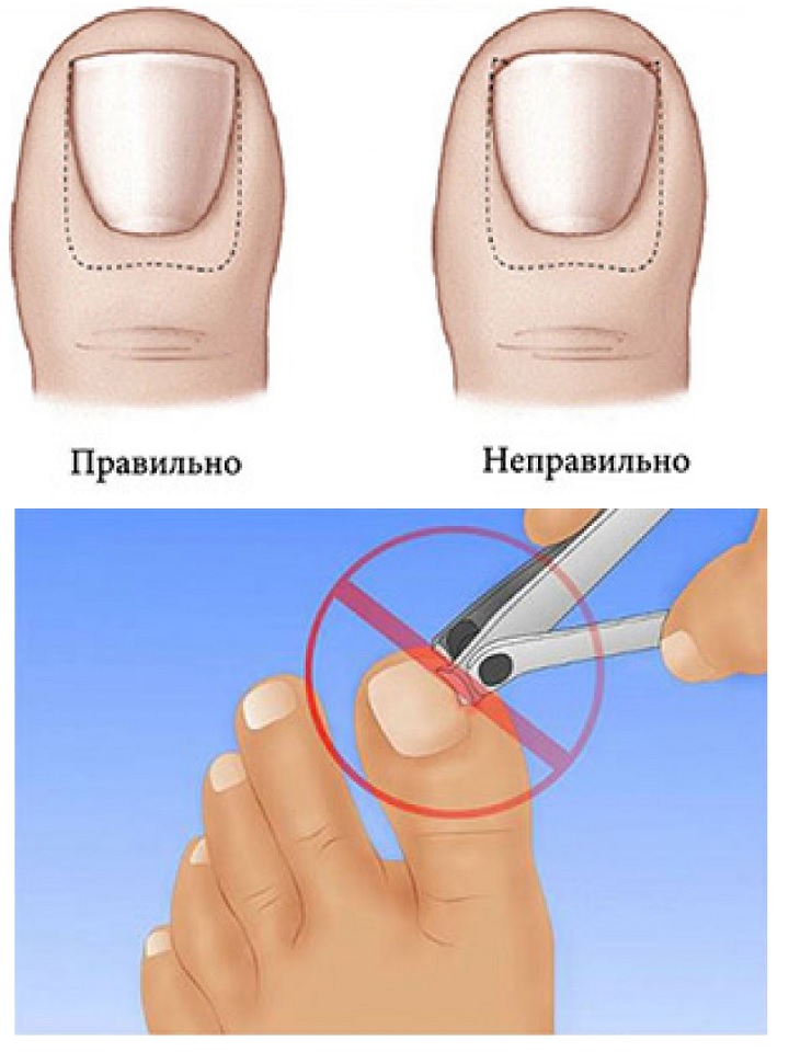 Удаление вросшего ногтя лазером: преимущества, как проводится | food and health
