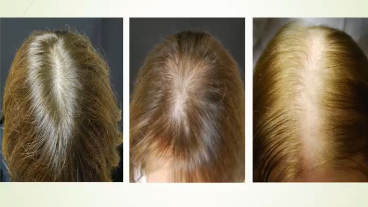 Советы трихолога для роста волос | блог клиники медиэстетик