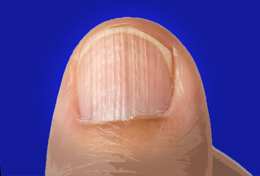 Почему ногти стали ребристыми вертикально