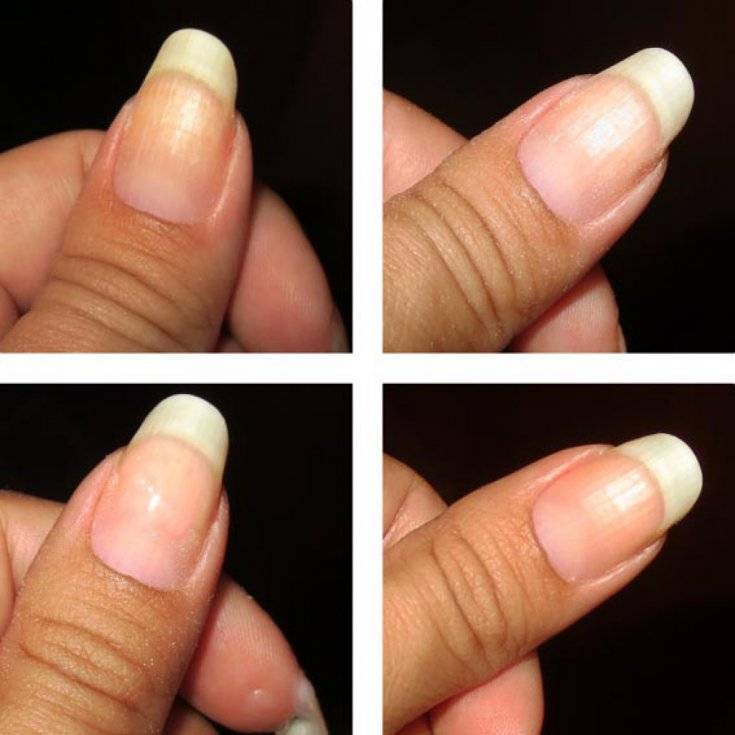 Способы отбеливания ногтей