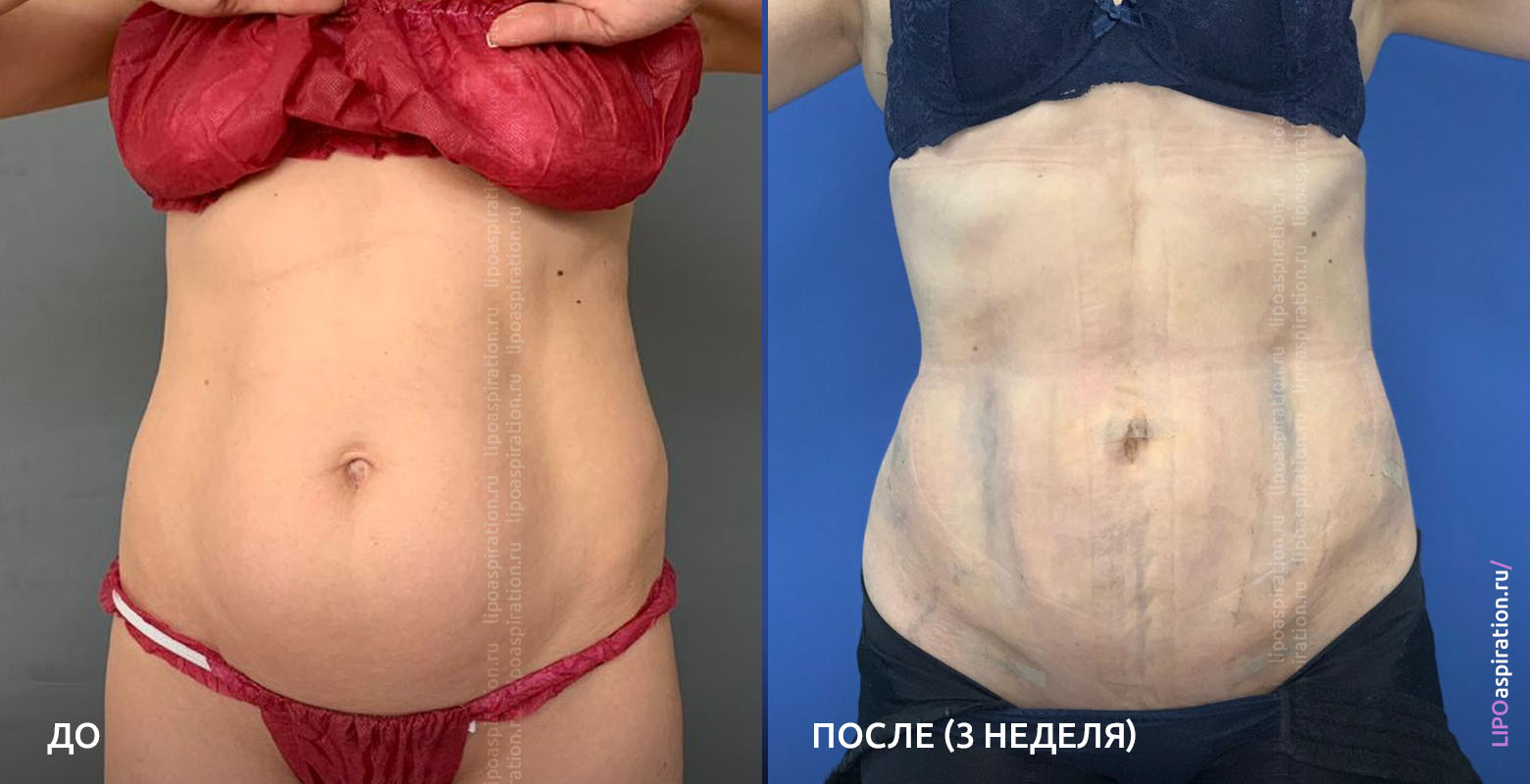 Лазерная липосакция живота, подобородка, лица, бедер, щек. сколько стоит лазерная липосакция. | медафарм - портал о пластической хирургии,медицинском оборудовании и медицине в целом