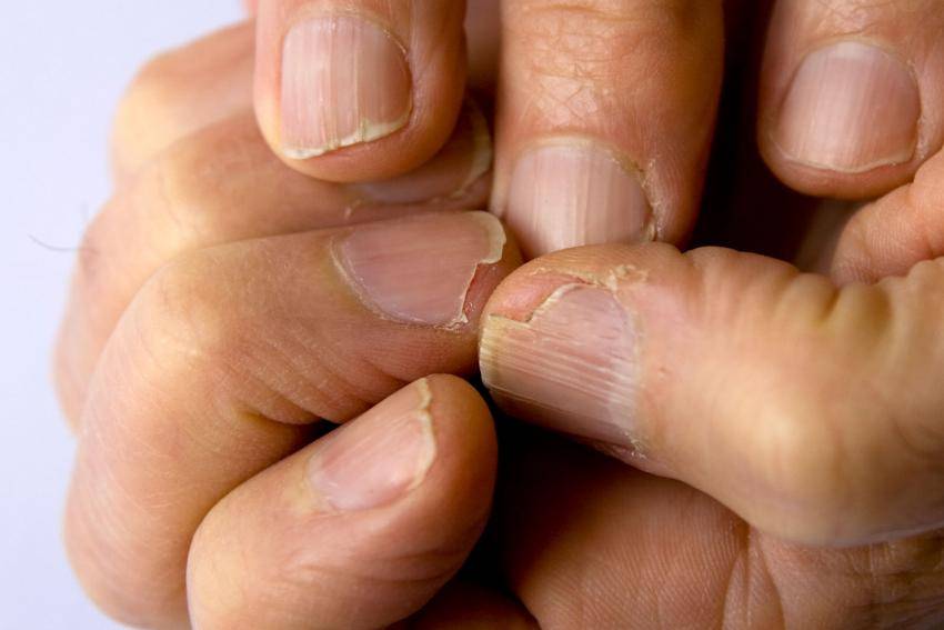 Возможные причины расслаивания ногтей у ребенка на руках и методы укрепления ногтевой пластины