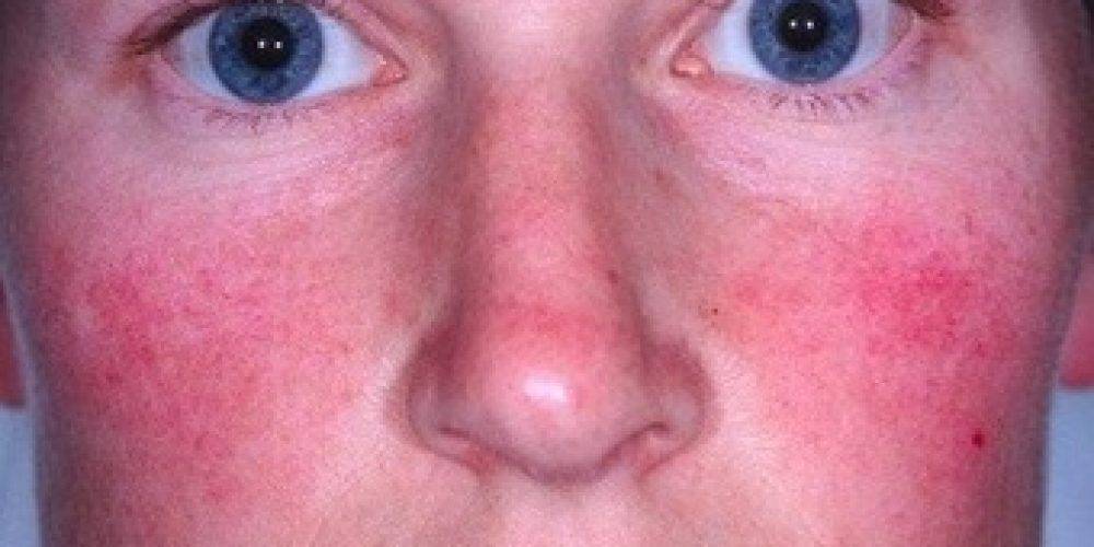Аллергия на лице у взрослых и детей: причины, симптомы, лечение