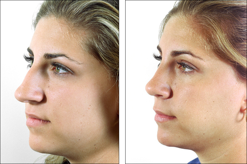 Как происходит пластика курносого носа? фото до и после операции
