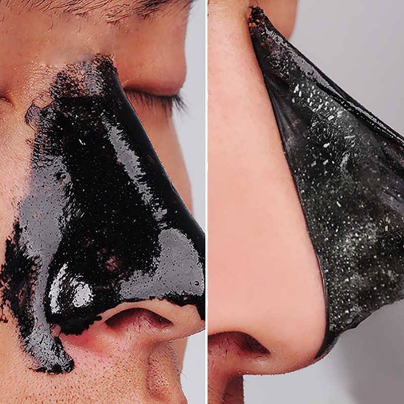 Как избавиться от черных точек на лице - эффективные способы удаления комедонов на лице
