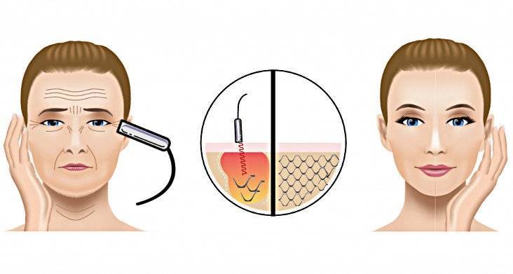 Термолифтинг лица - процедура глубокого лифтинга кожи с помощью радиоволновой подтяжки коллагеновых волокон
