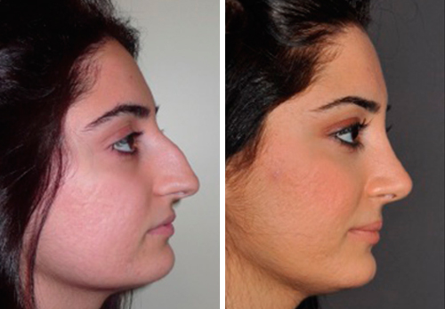 Ринопластика носа, фото до и после ринопластики