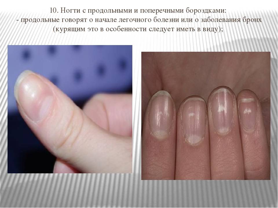 Определить болезни по ногтям на руках фото