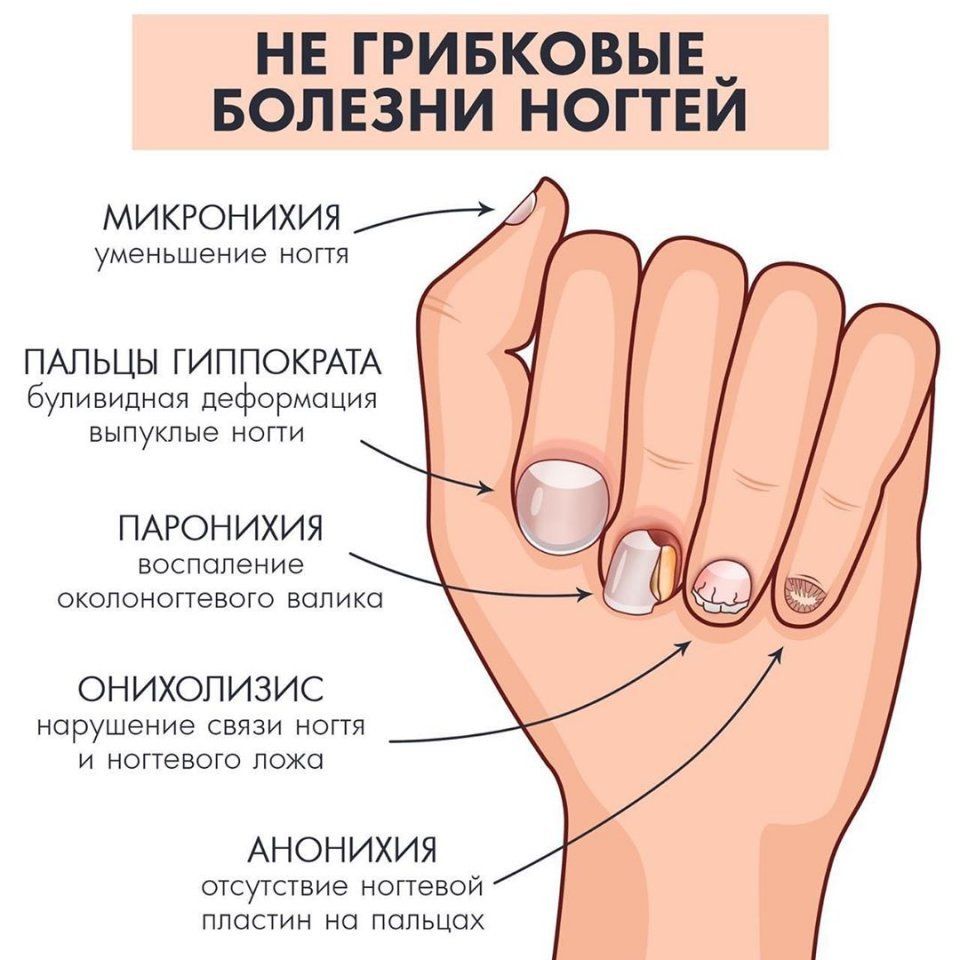 Деформация ногтей на руках причины и лечение. фото и видео болезни