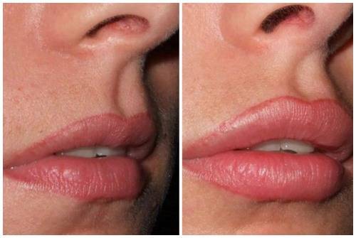 Хейлопластика (пластика губ), увеличение губ операцией | стоимость коррекции верхней и нижней губы