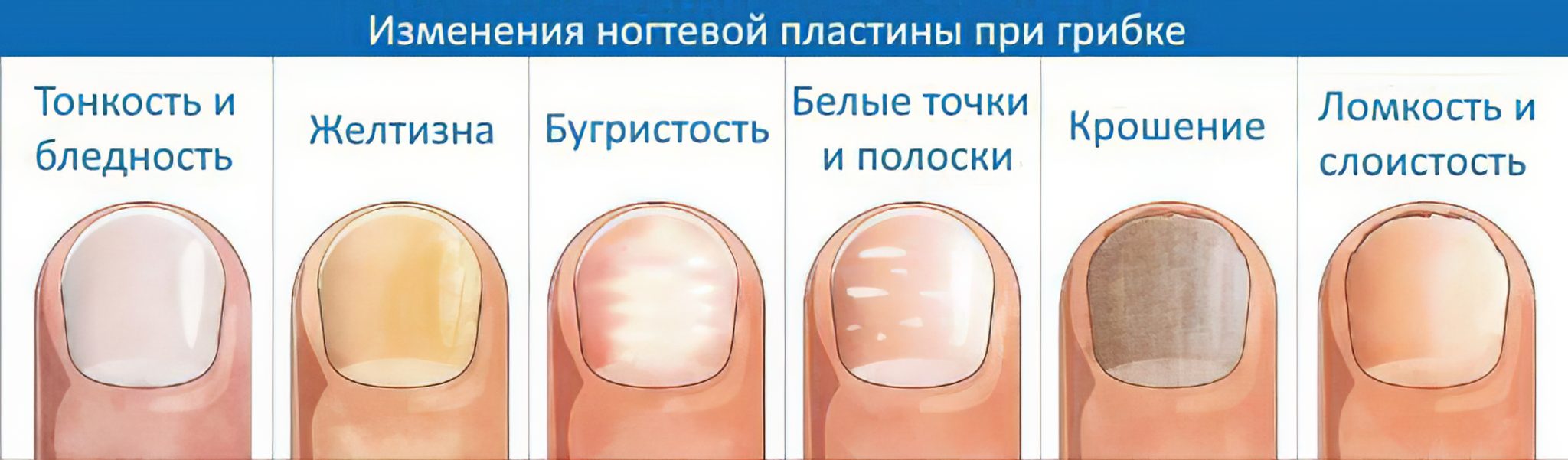 Темные пятна на ногтях - основные причины и лечение