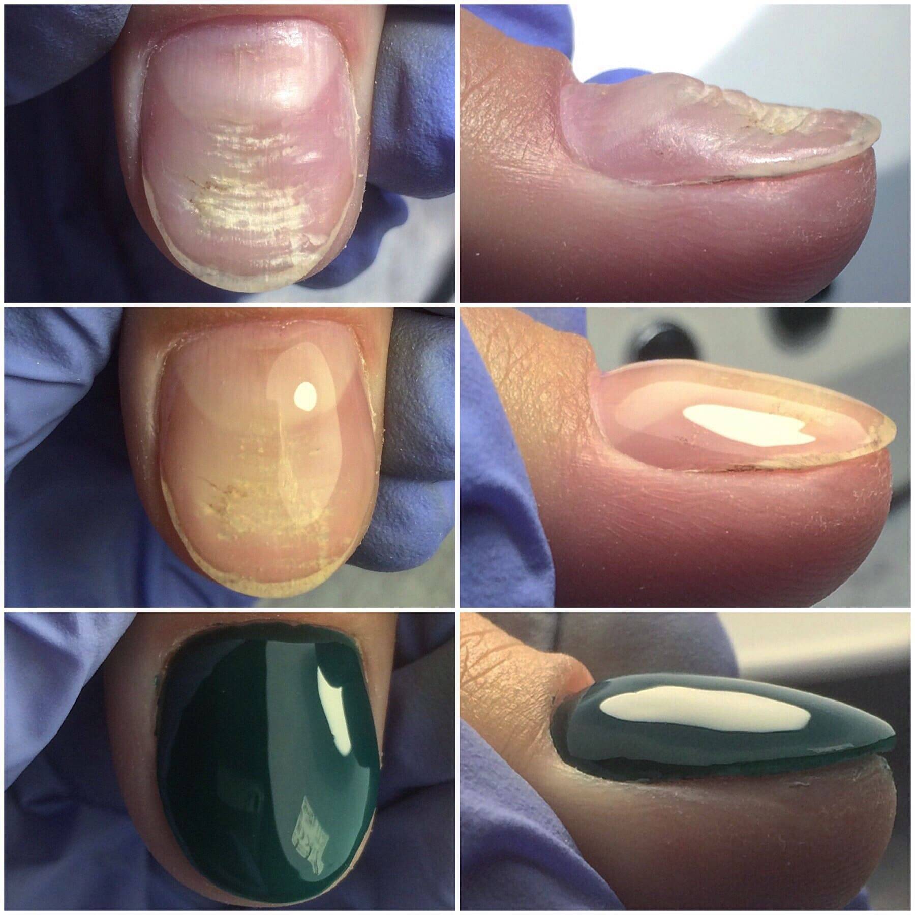 Процедура выравнивания ногтевой пластины базой. как правильно подобрать средство?