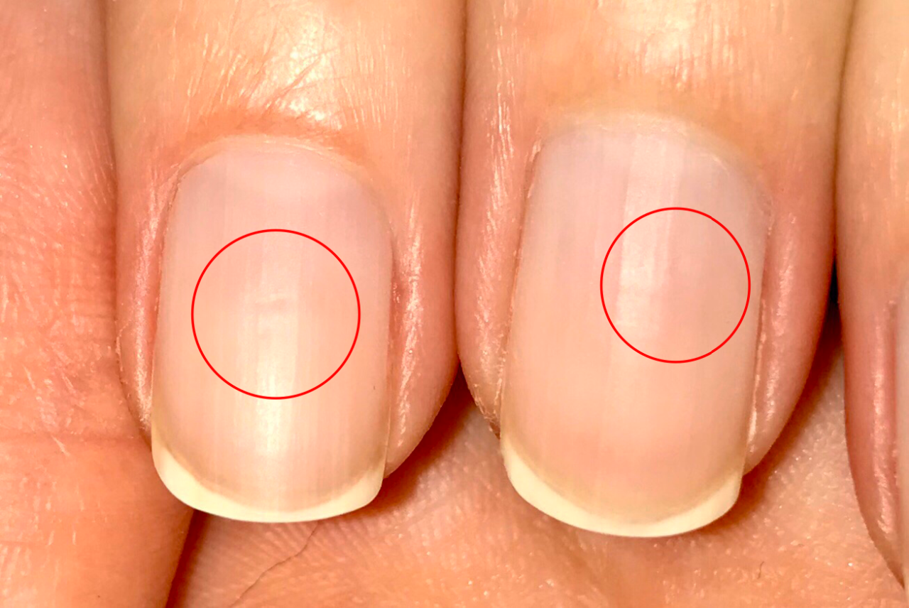 Полосы на ногтях - продольные или поперечные, причины появления, диагностика, методы лечения и профилактика