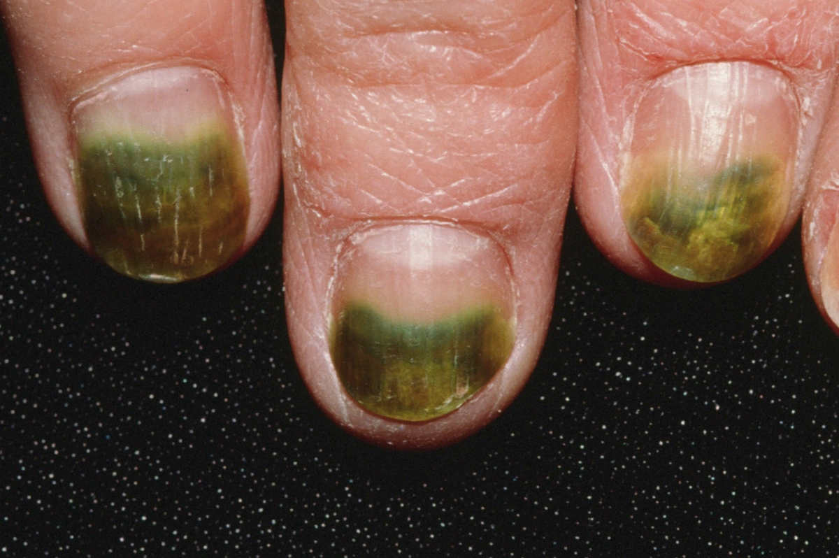 Как понять что у вас грибок ногтей — статья от клиники new skin clinic