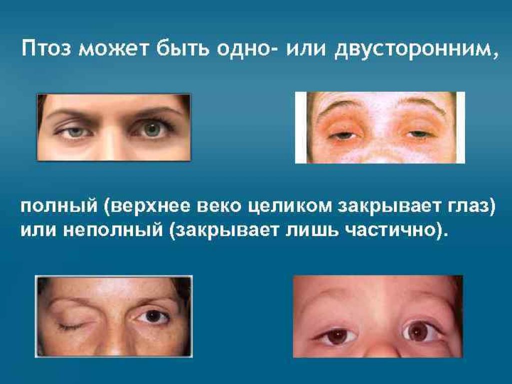 Птоз глаза - виды, признаки, лечение
