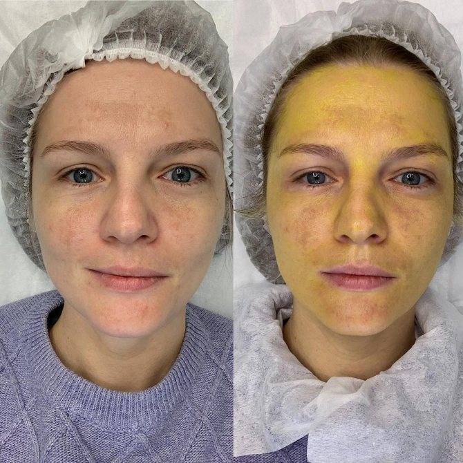 Процедуры для проблемной кожи лица. ретиноевый "желтый" пилинг: мой первый опыт и ощущения, консультация дерматокосметолога, фото результатов