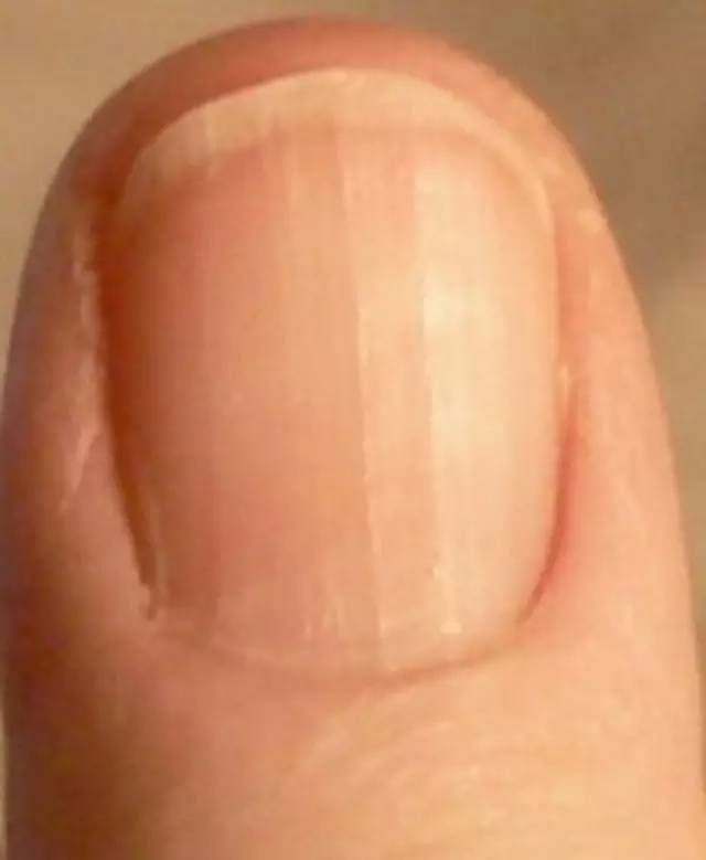 Белые пятна на ногтях: причины, почему появляются белые полосы и пятна на ногтях