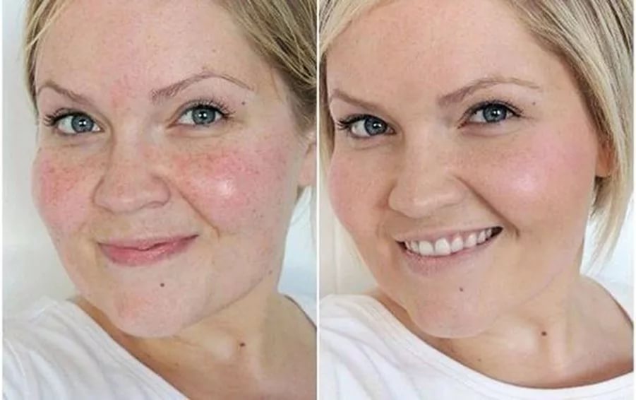 Как улучшить тусклый цвет лица | медицинская клиника в санкт-петербурге