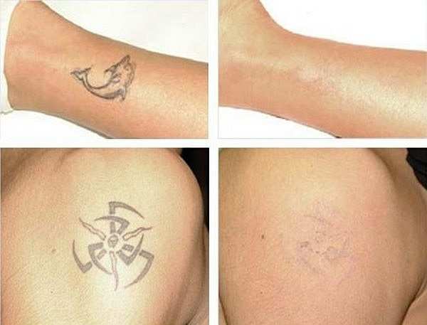 Удаление татуажа и перманентного макияжа: 6 способов