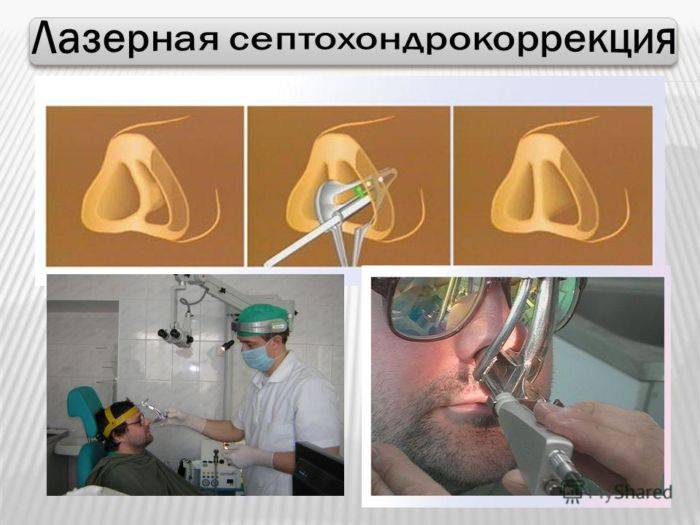 Лазерная коррекция носовой перегородки в краснодаре -лазерные методы | лор-клиника "солнце"