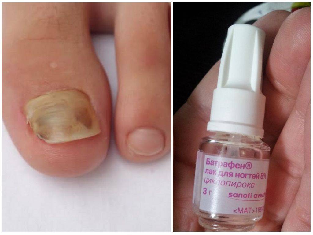 Лазерное лечение грибка ногтей: показания, противопоказания | food and health