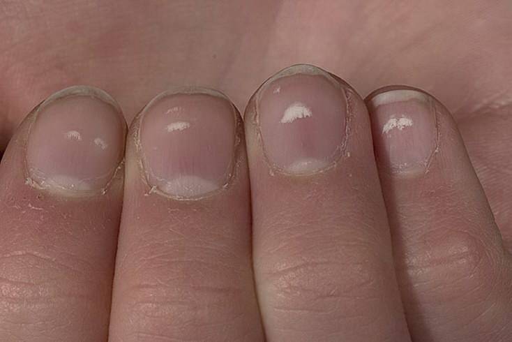 Причины появления белых пятен на ногтях