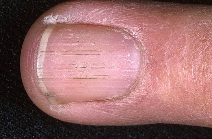 Черные полоски на ногтях рук и ног: что это значит, и описание основных причин появления, фото, лечение и профилактика